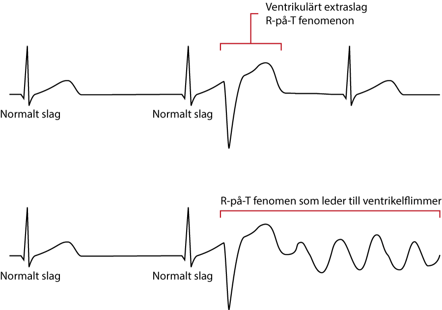 Ventrikulära extraslag (VES) EKG.nu
