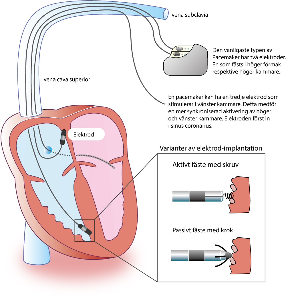 pacemaker EKG.nu