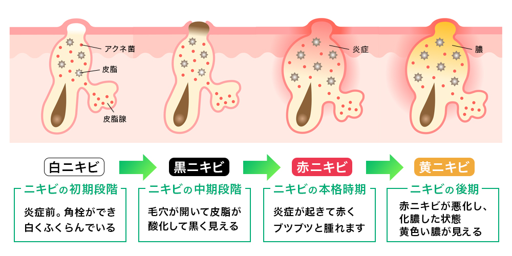 ニキビ治療とその原因・種類 【公式】銀座・新宿の美容皮膚科エルクリニック