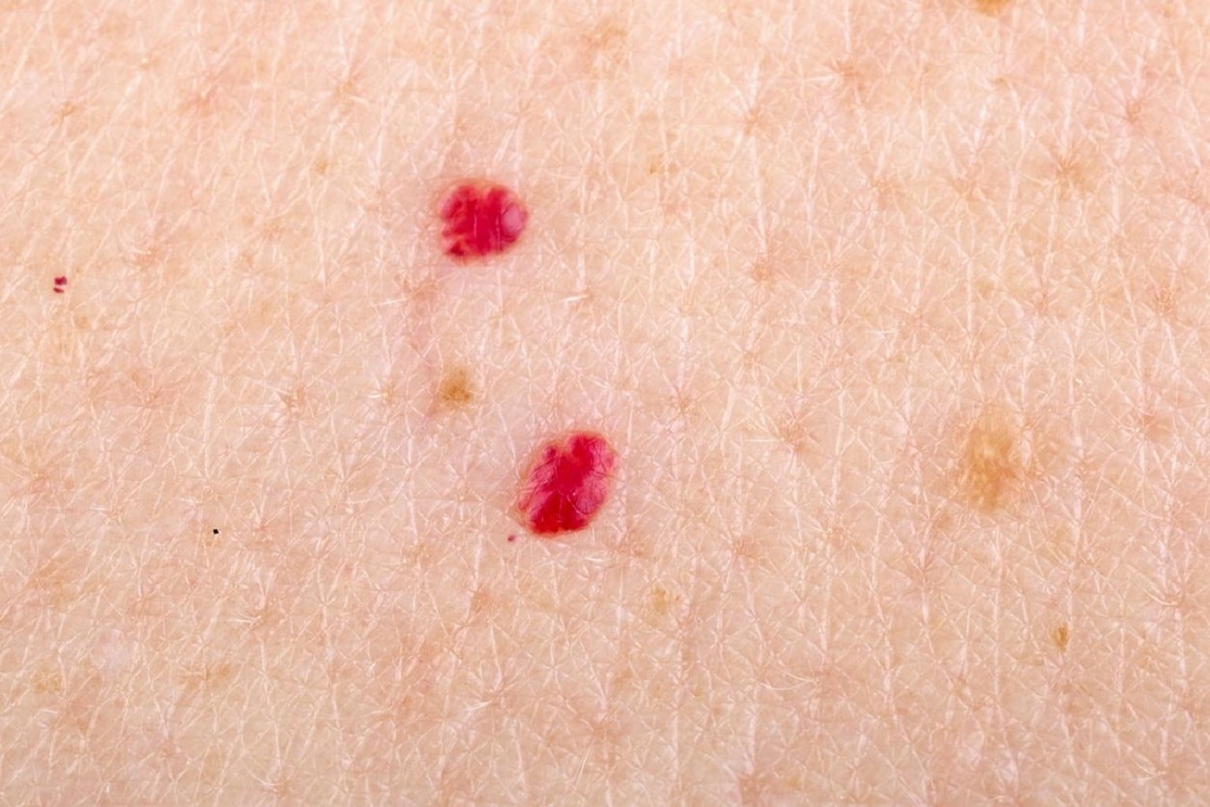 Angiomas ¿qué son y por qué aparecen puntos rojos en la piel?