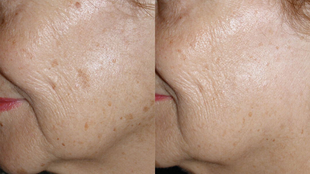 IPL Skin Rejuvenation Electa
