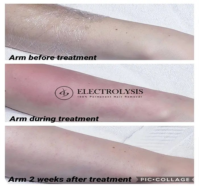 Electrolysis Before and After 100 Permanent Hair Removal