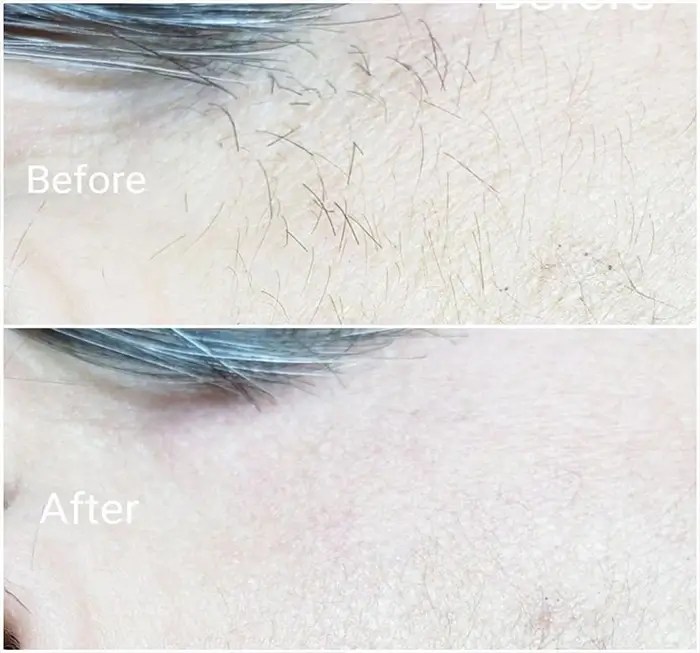 Electrolysis Before and After 100 Permanent Hair Removal