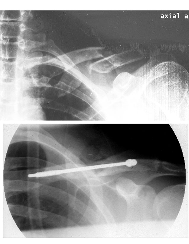 Travel destinations/activities with a broken collarbone vacation
