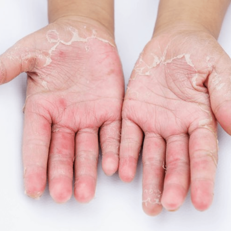 Q&A Series 21 Q My hands have been itchy for the past 3 months and the skin on my palms