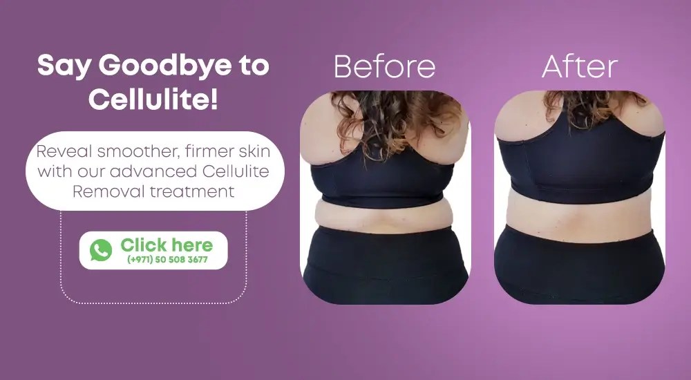 What treatment do celebrities use for cellulite? elegant hoopoe