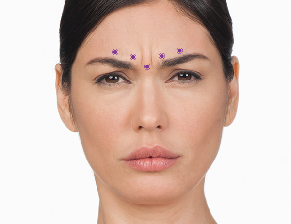 Botox Injections Medspa Tempe