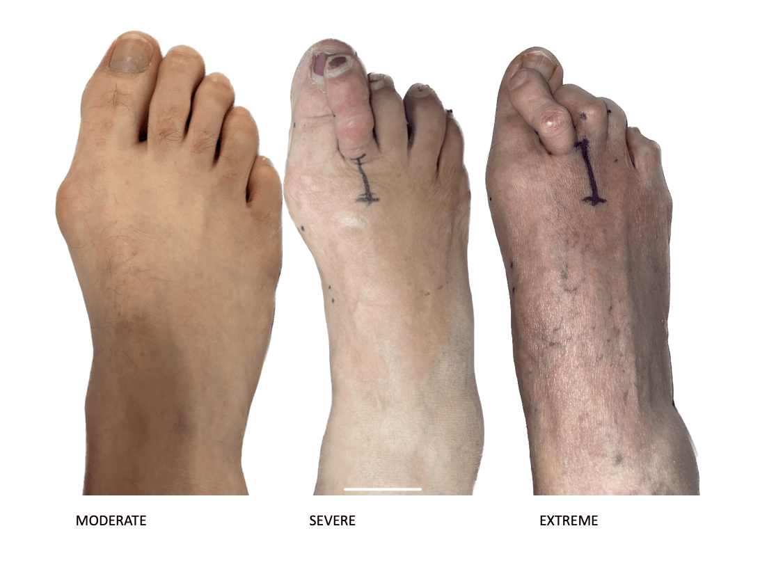 Minimally Invasive Bunion Surgery Elevate Foot & Ankle