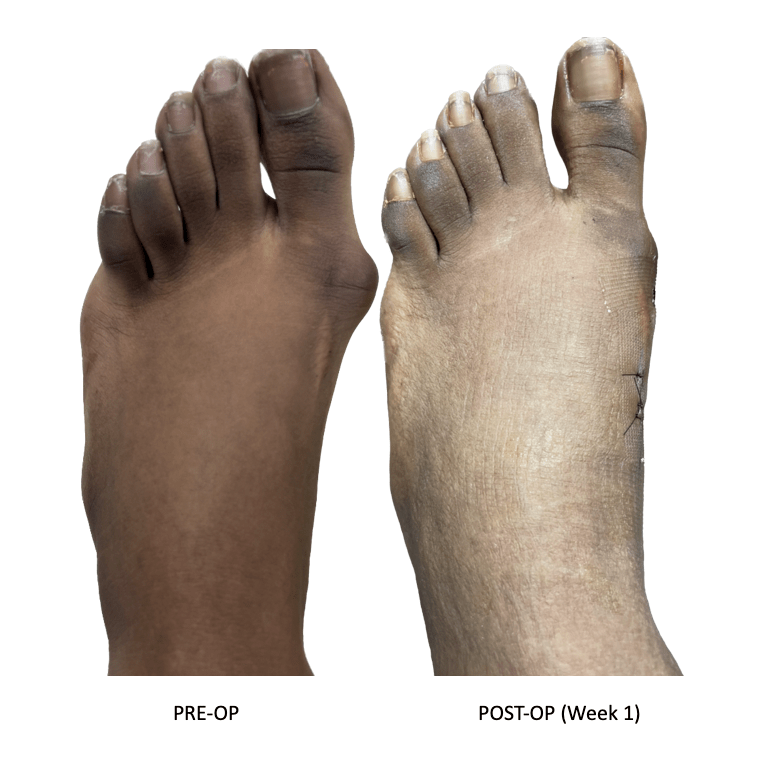 Minimally Invasive Bunion Surgery Elevate Foot & Ankle