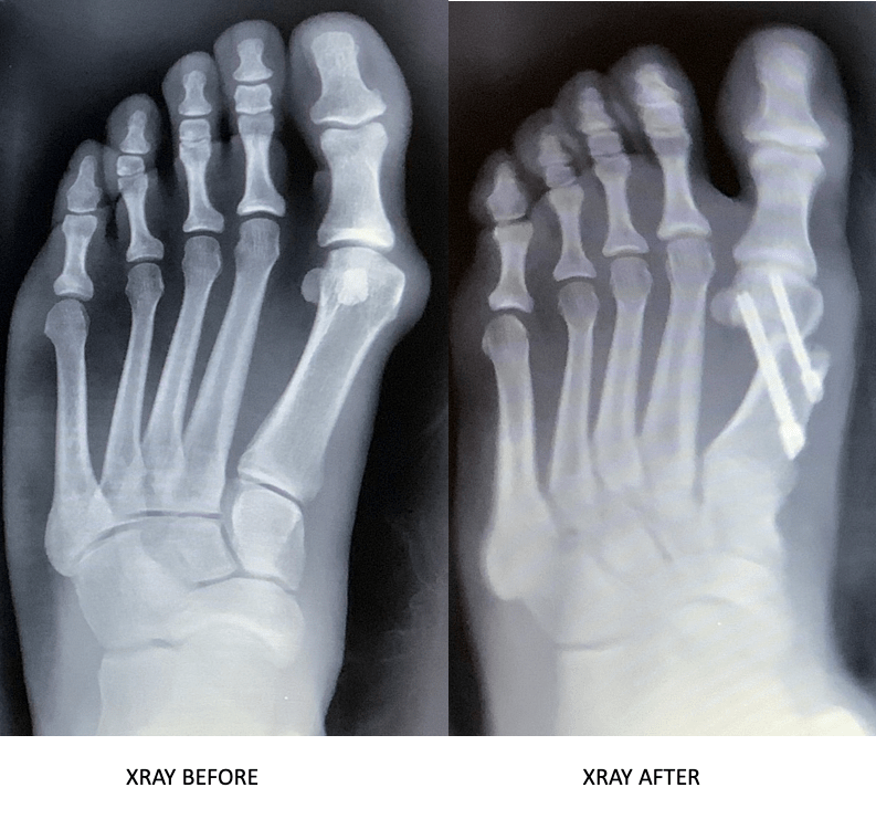 Minimally Invasive Bunion Surgery Elevate Foot & Ankle
