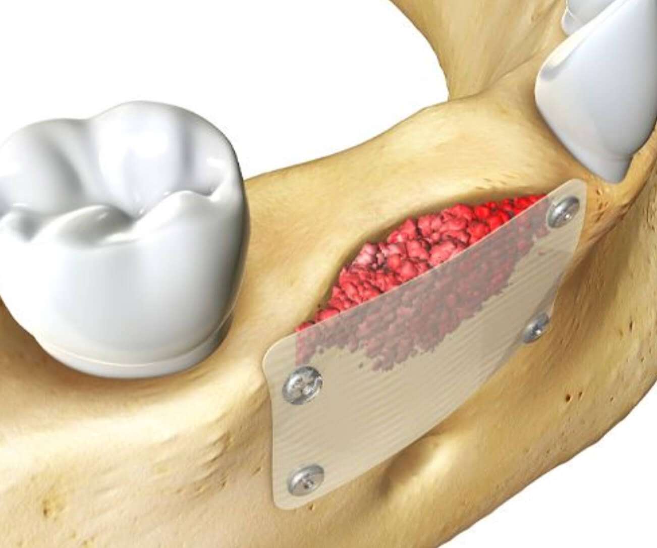 Bone Grafting Oral Surgery in McLean VA by Elevation Center for Oral, Implant, and Facial Surgery