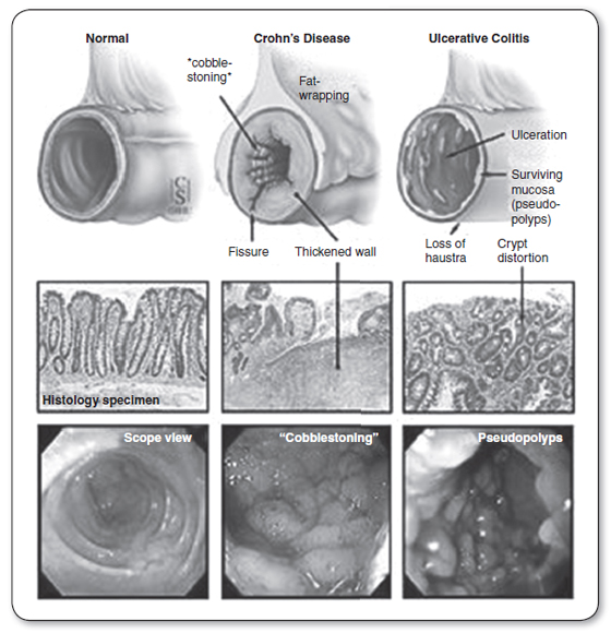 Crohns fissure Anal Fissures and Hemorrhoids in Crohn’s Disease