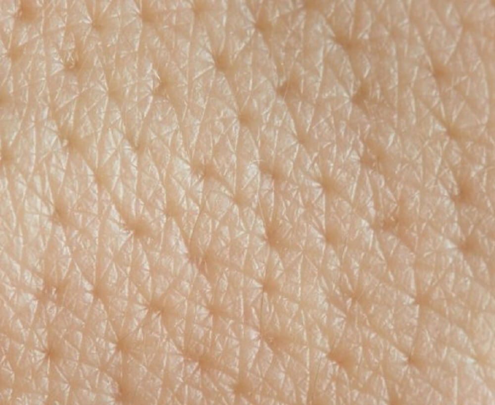 Waxy skin patches Seborrheic keratosis Symptoms and causes