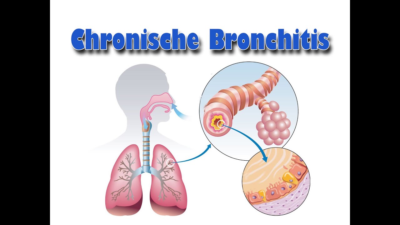 Steroid pack for bronchitis Acute Bronchitis Treatment, Symptoms