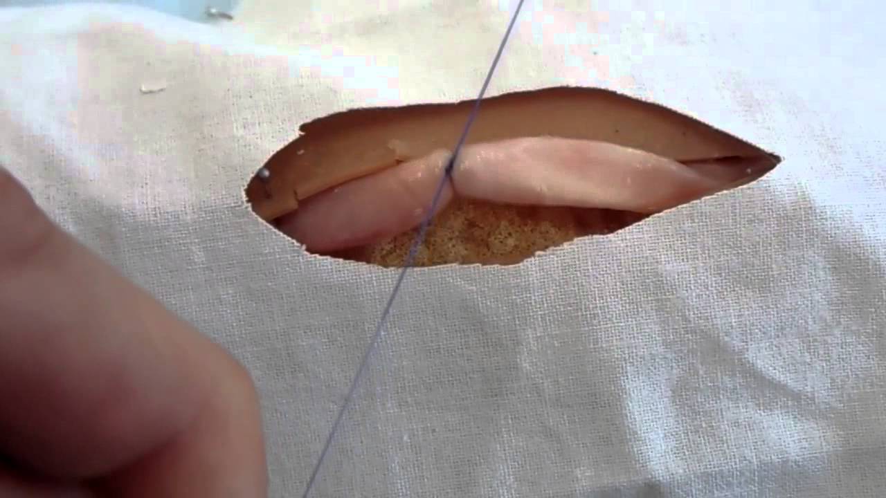 Bleeding after suture removal Suture Removal Samuel A. Taylor, MD