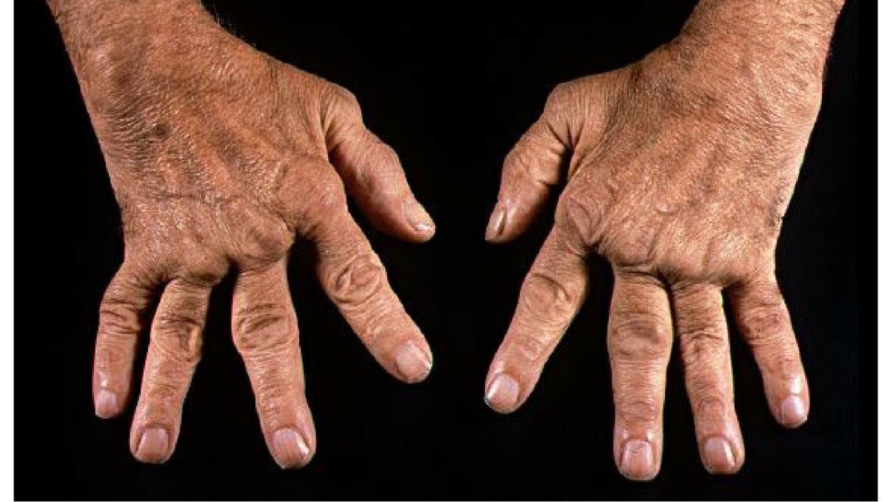 Rheumatoid arthritis knuckles Arthritis of the Hand Symptoms, Types