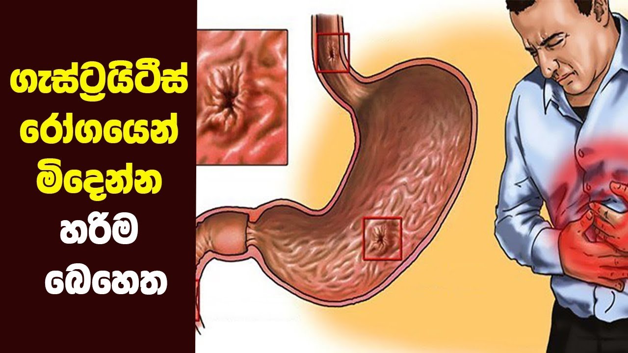 Does gastritis cause weight loss Everything You Need to Know About