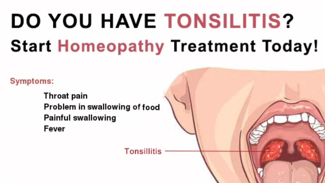 How do i know if i have tonsil stones How Do You Know if