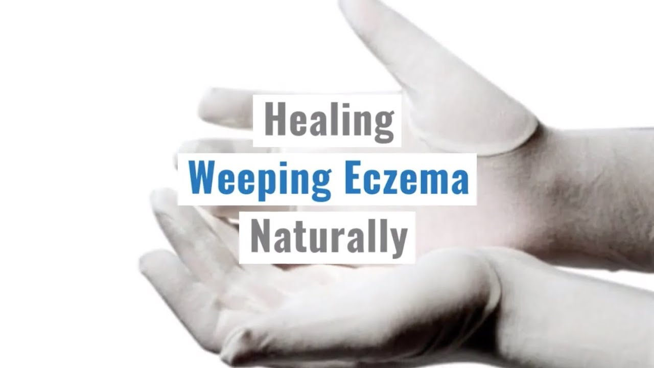 Weeping eczema in babies Eczema in babies, children and teenagers