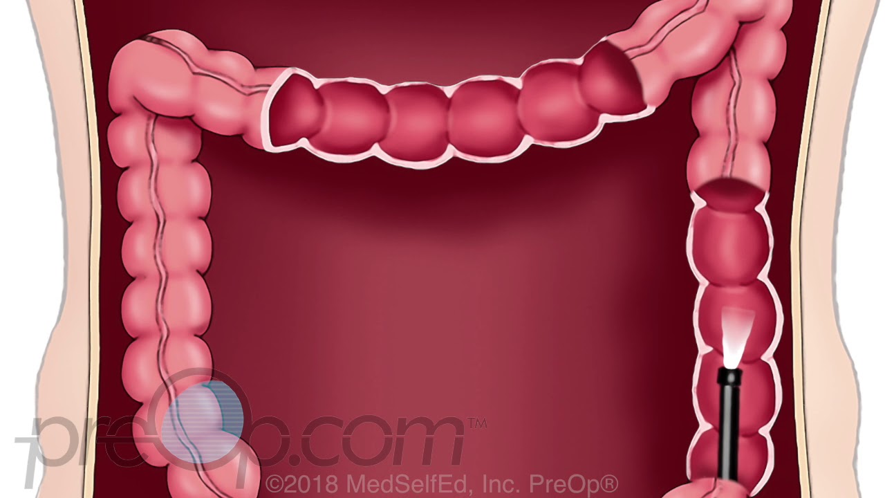 What instrument is used to perform a lower gi endoscopy GI Endoscopy