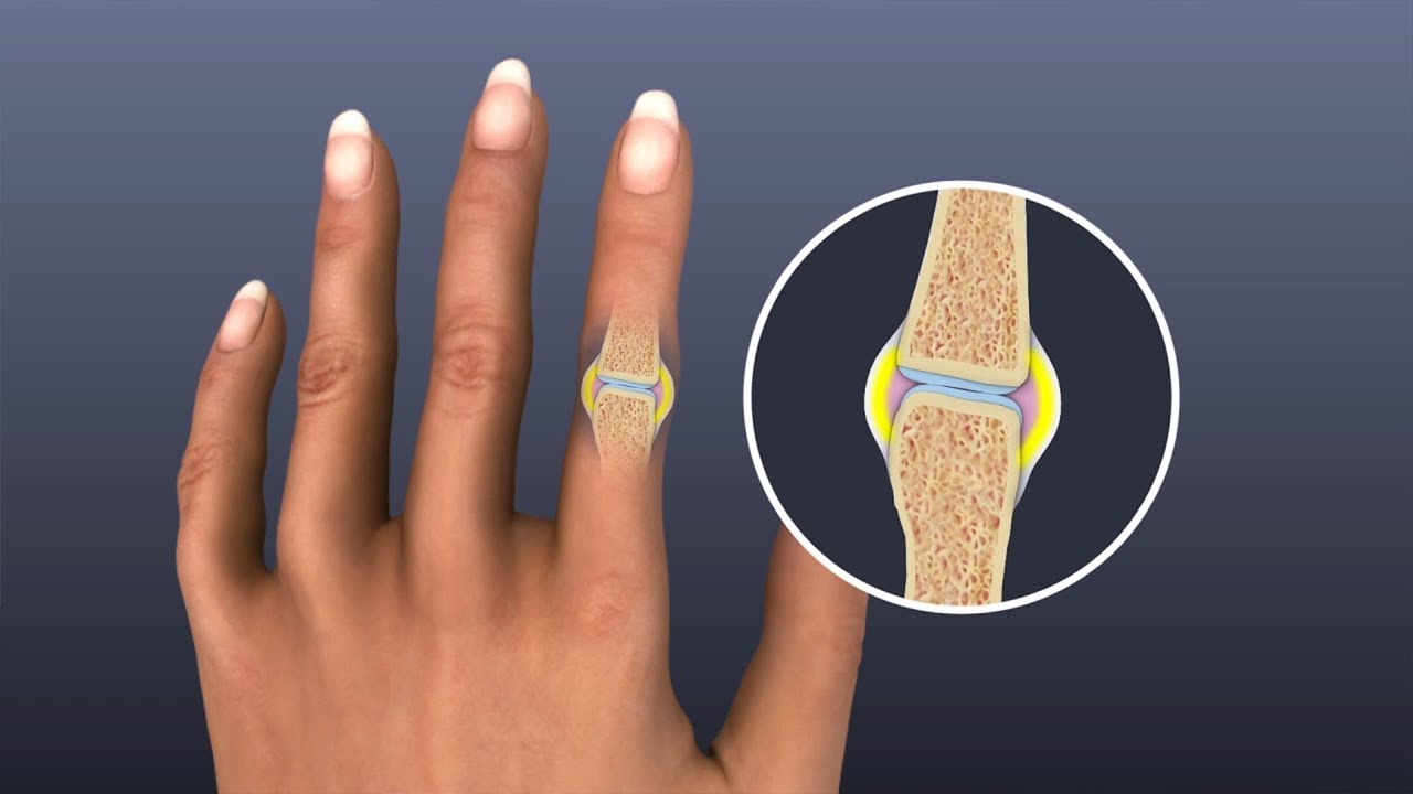 Knuckle pain and swelling Knuckle Pain Causes, Treatment, and