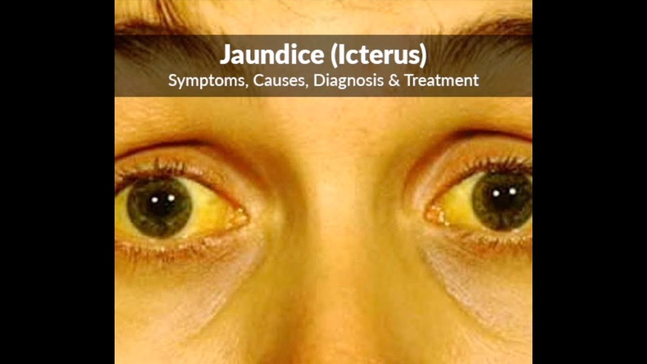 Jaundice disease definition Jaundice causes Information Mount Sinai