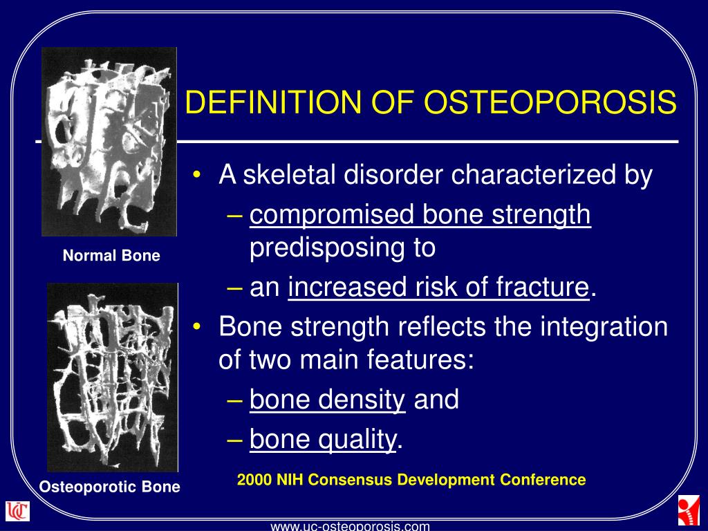 Causes of bone density loss Low Bone Density > Fact Sheets > Yale