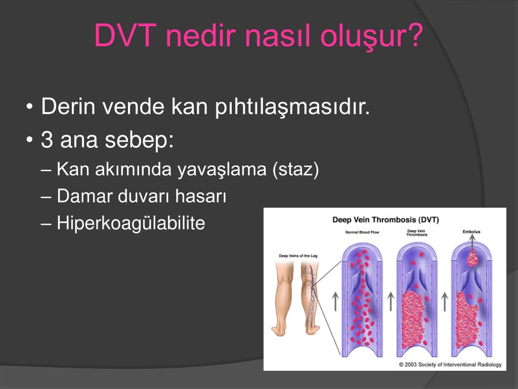 Aspirin deep vein thrombosis Does aspirin prevent venous