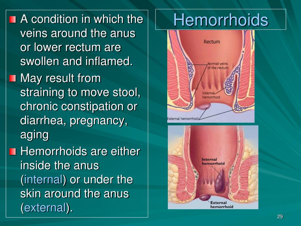 Can hemorrhoids cause flattened stool What causes flat poop? Treatments and home remedies