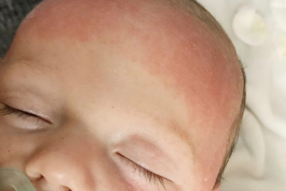 Weeping eczema in babies Eczema in babies, children and teenagers