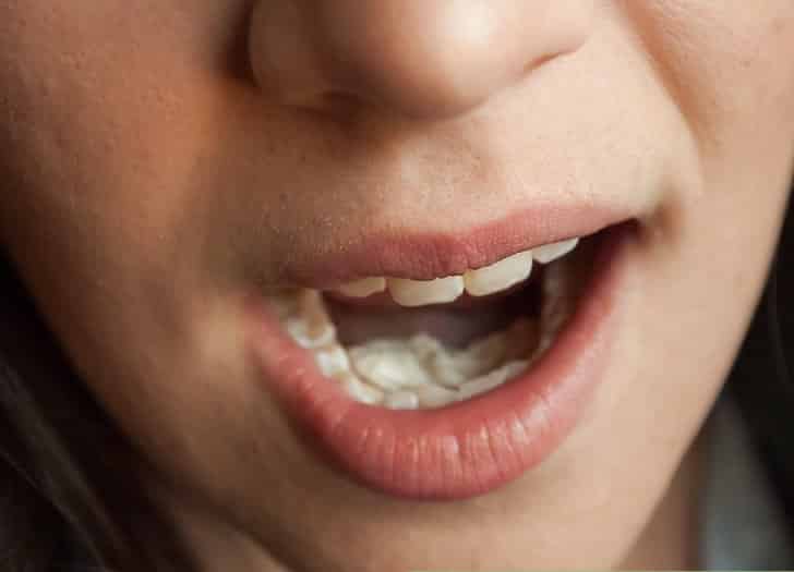 Being Annoyed By Noisy Chewing Is A Genuine Psychiatric Disorder, Study