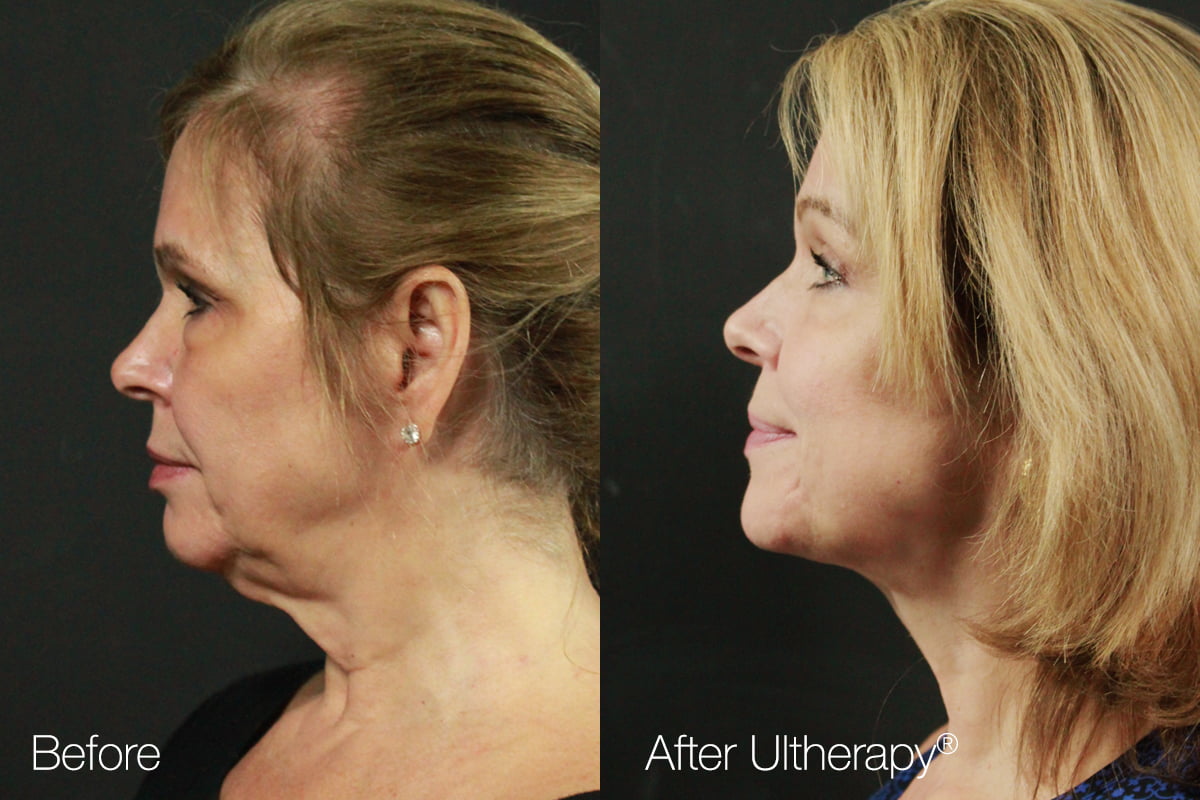 Ultherapy Columbus, OH Noninvasive Face Lift at Elite Body and Laser