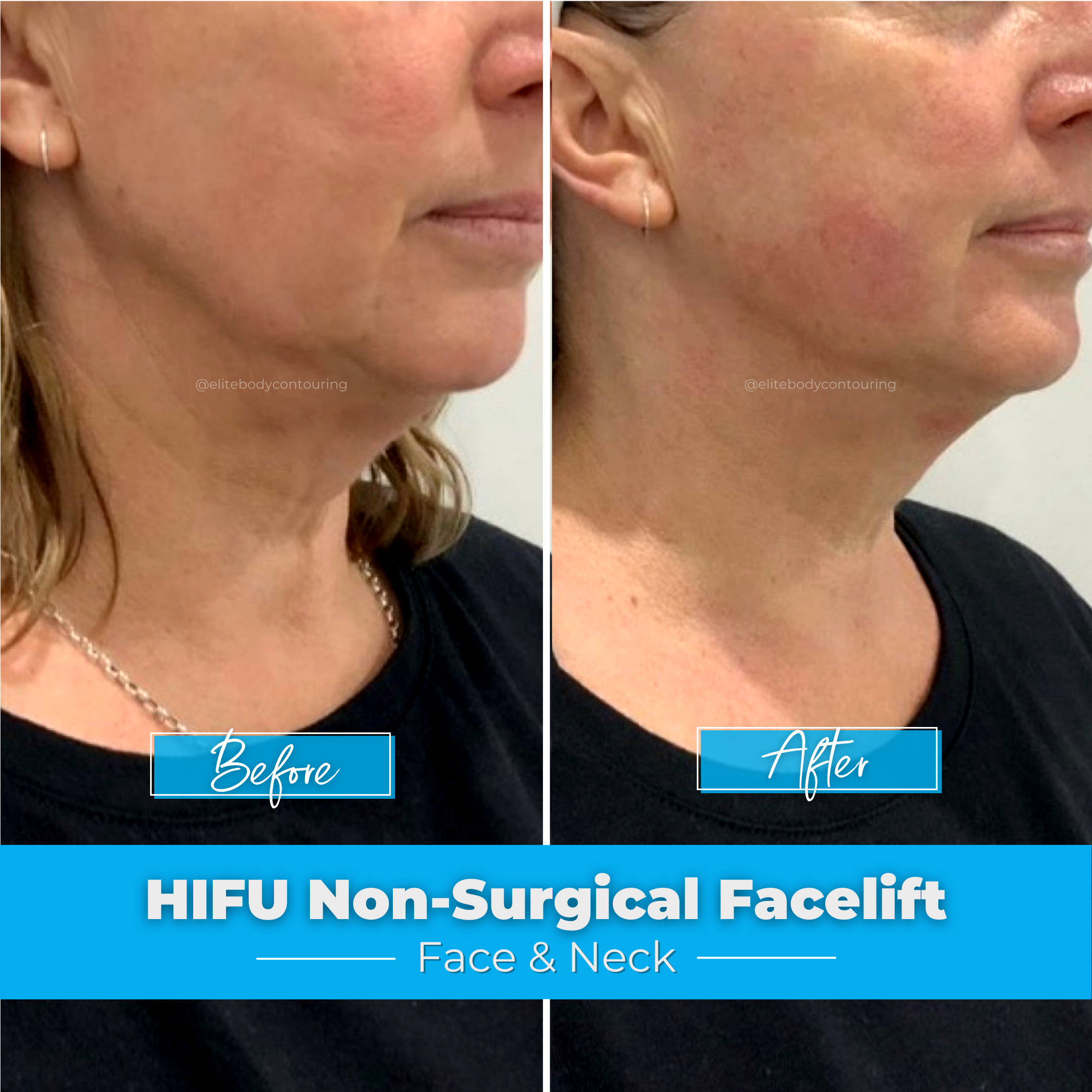 HIFU NonSurgical Facelift Sydney Elite Body Contouring