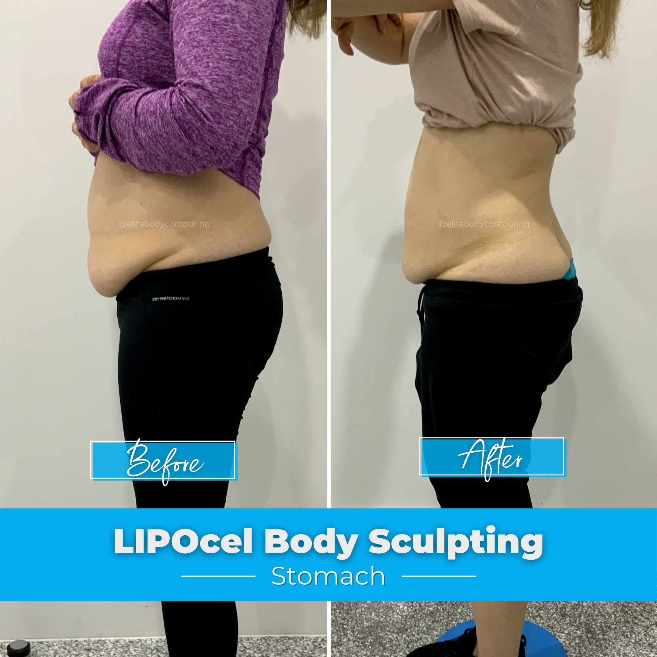 LIPOcel Body Sculpting Results Elite Body Contouring