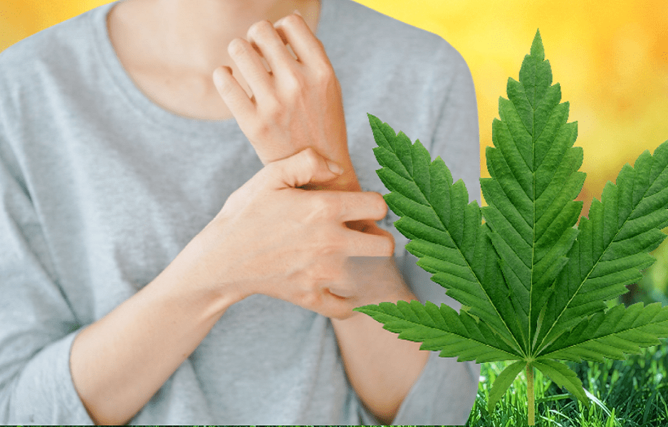 Medical Cannabis For Psoriasis Best Strain For Treatment, Benefits