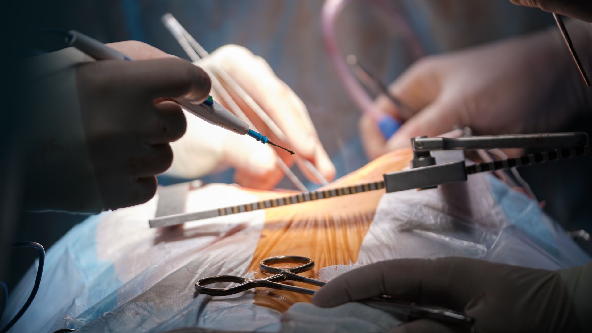 Infected Surgical Incision - Elite Hospital Kingwood