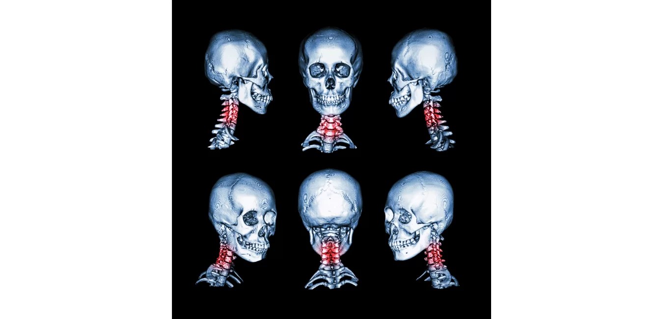 How Cervical Spondylosis Occurs and How To Treat It Elite Spine Centres