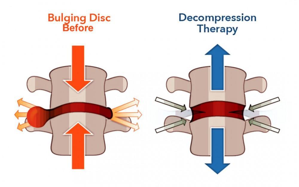 Do You Have A Herniated Disc Or Sciatica? Try Spinal Decompression
