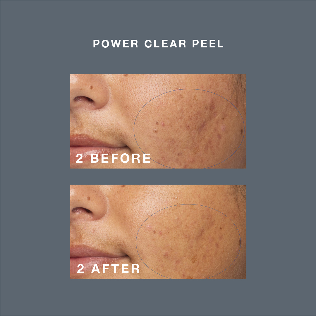 Pro Power Peel 30 Elixir Beauty