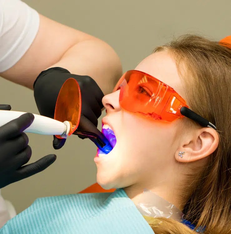Dental Sealants Everything You Need to Know Dr. Elizabeth Watt