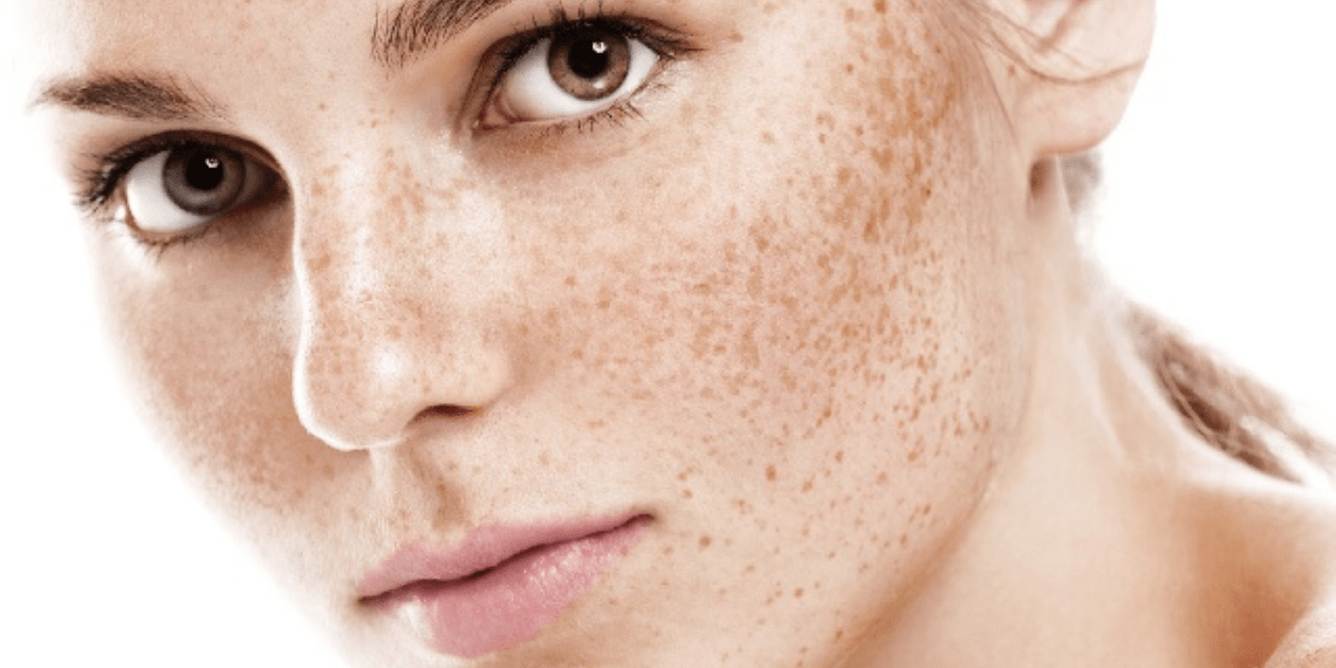 facial discoloration