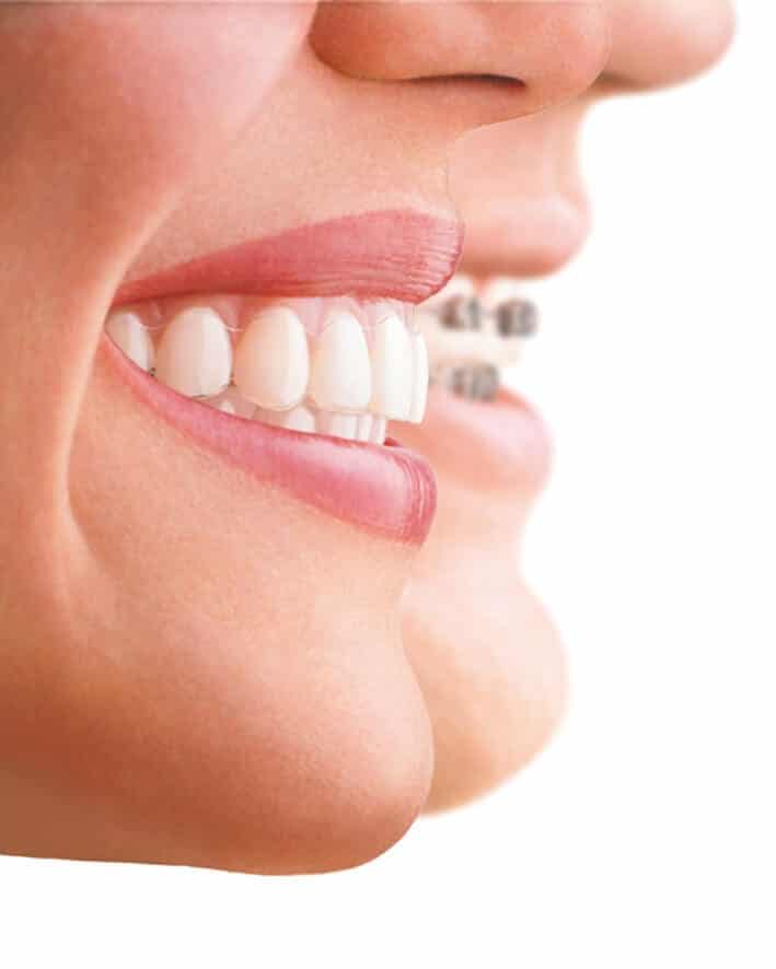 How Long Will I Need to Wear a Brace? Elleven Dental