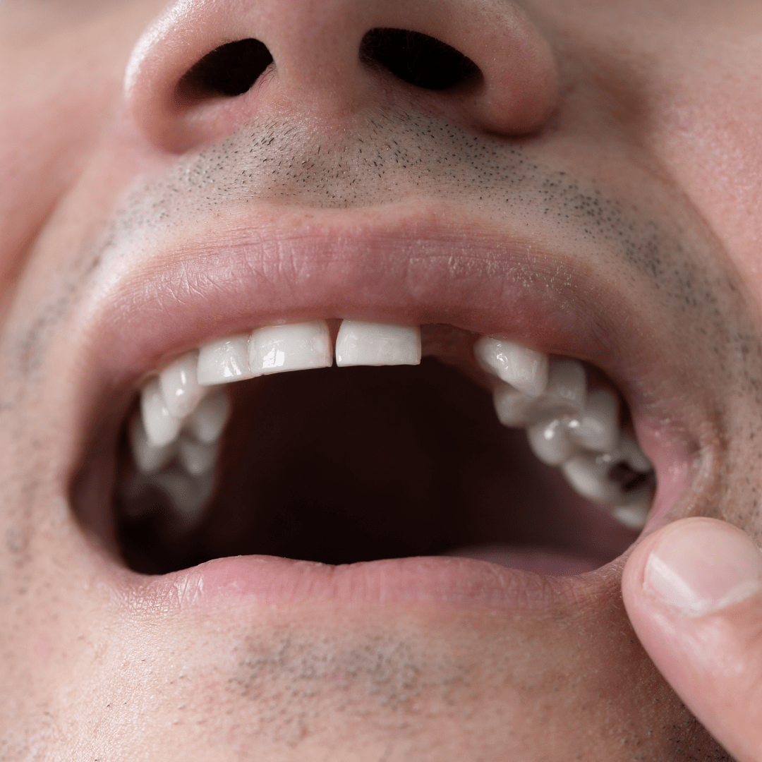 Why Do We Dream About Our Teeth Falling Out? Ellicott