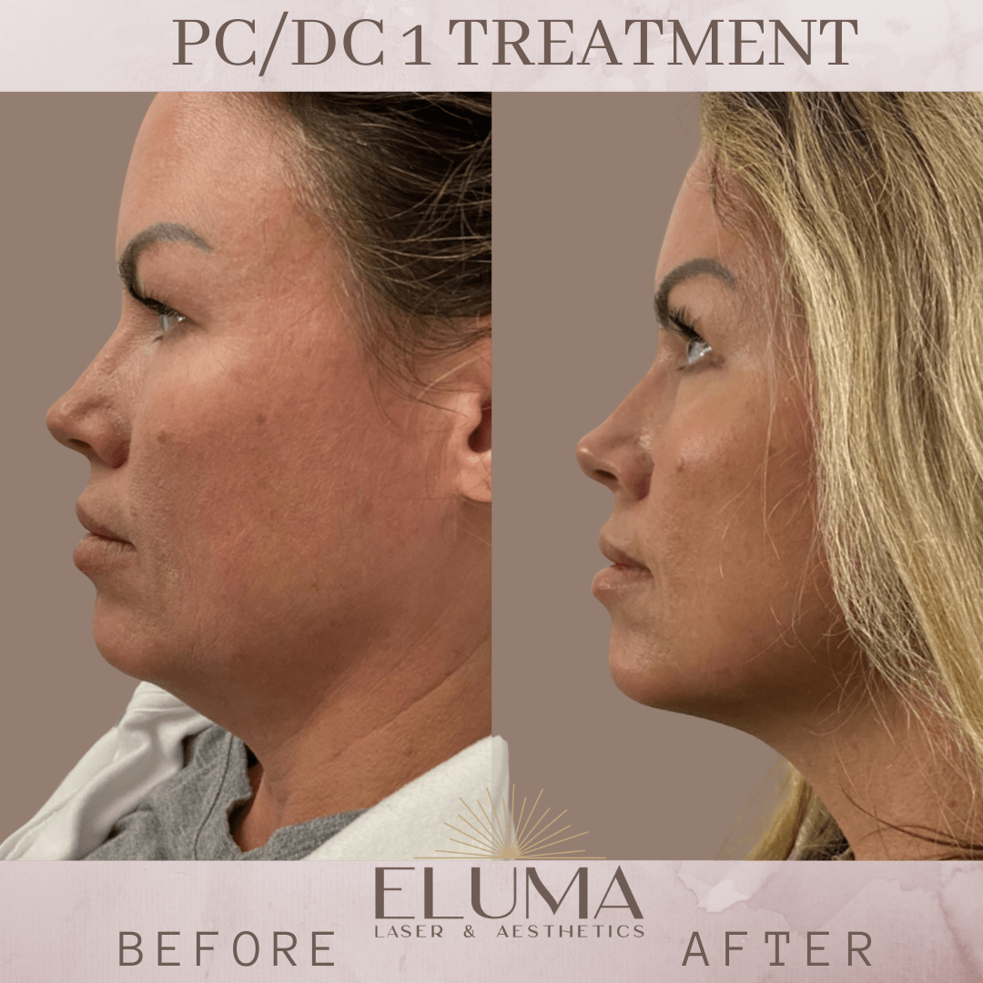 Kybella Eluma Laser & Aesthetics