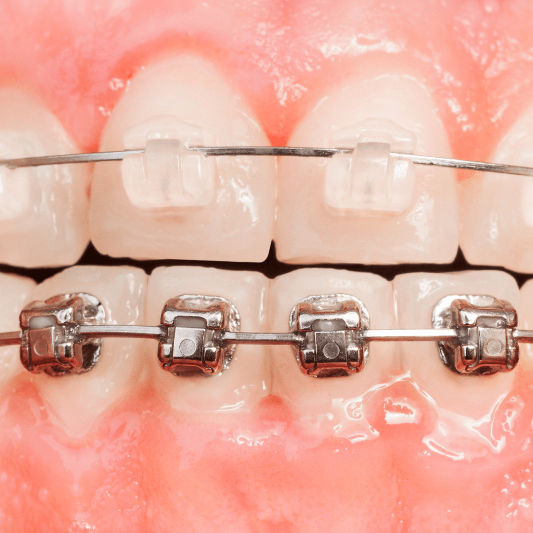 Clear Ceramic Braces For A More ‘Invisible’ Look From Ely Smiles