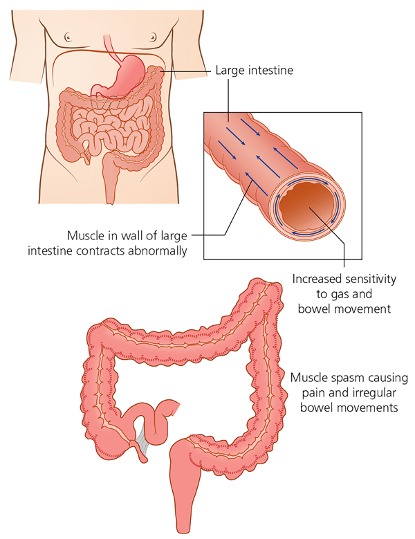 Irritable Bowel Syndrome General Information Embarrassing Problems