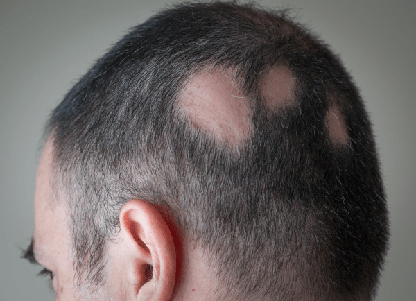 Bald Patches | Embarrassing Problems