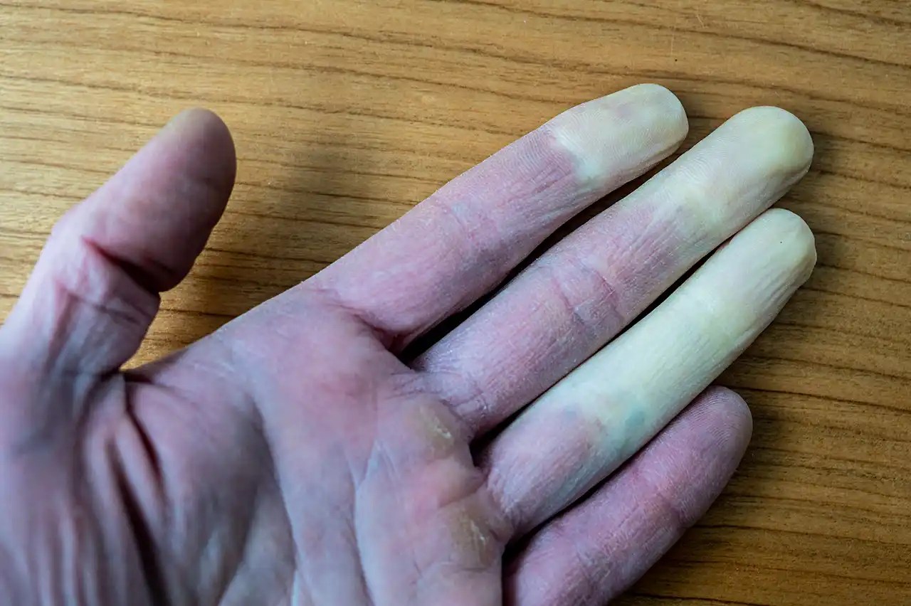 Raynaud’s Disease Top Foods to Relieve Raynaud’s Disease