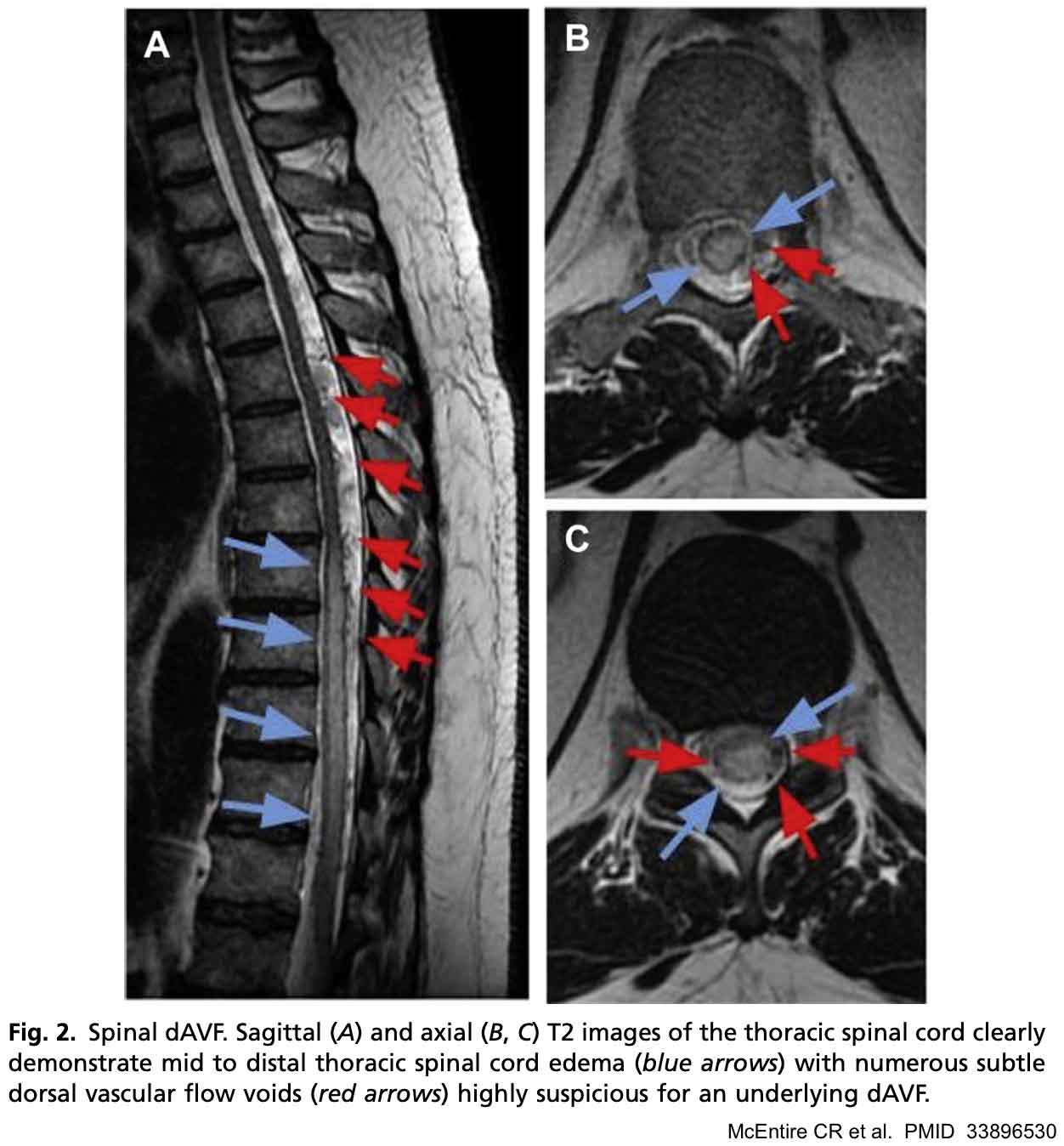 Spinal Cord Compression