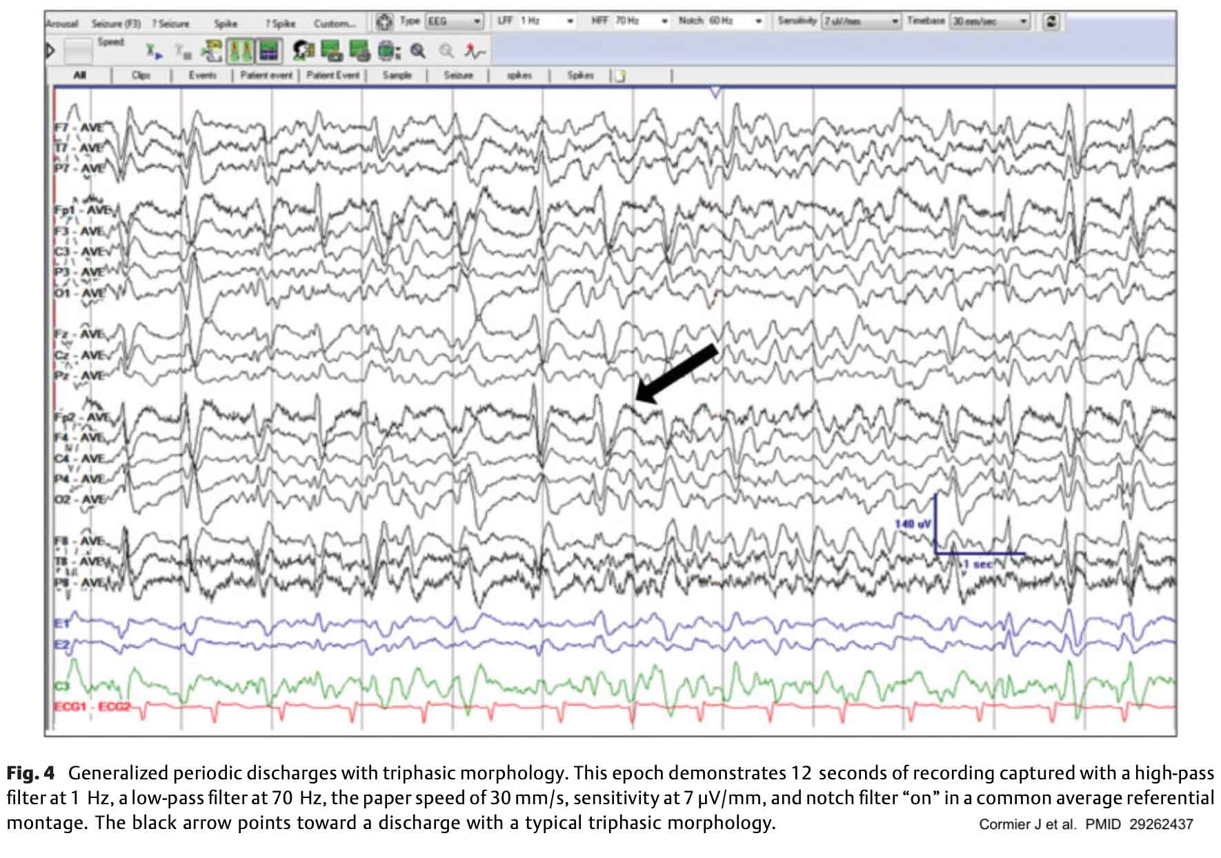 Normal Versus Abnormal Eeg